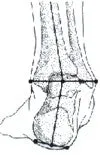 Superfeet Carbon Pro Hockey Skate Footbeds